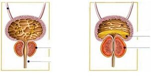 types and forms of prostatitis in men