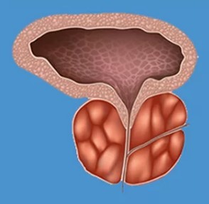 Typical symptoms of prostatitis