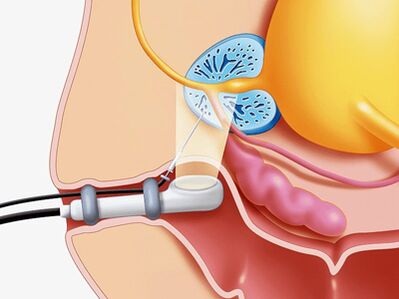 Puncture biopsy of the prostate