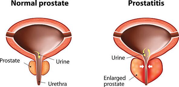 normal and inflamed prostate