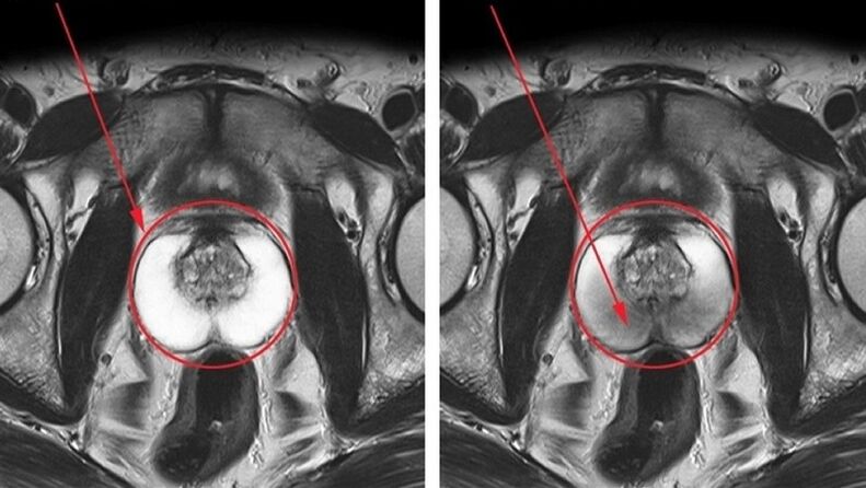 a healthy and inflamed prostate with chronic prostatitis