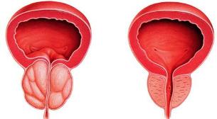 the difference is the patient and a healthy prostate