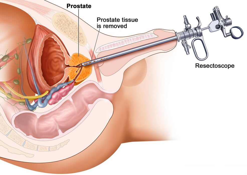 Collection of prostate tissue for accurate diagnosis of prostatitis